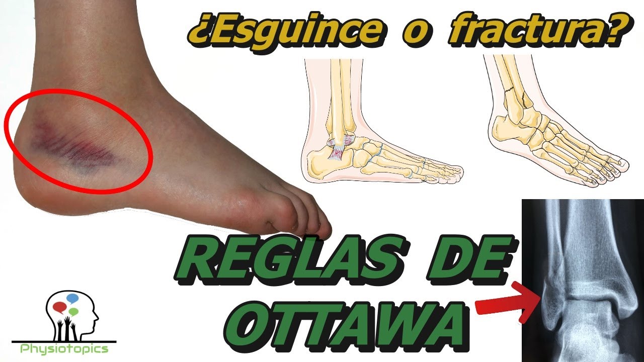 ¿Conoces la regla de Ottawa? Descubre cómo prevenir lesiones deportivas