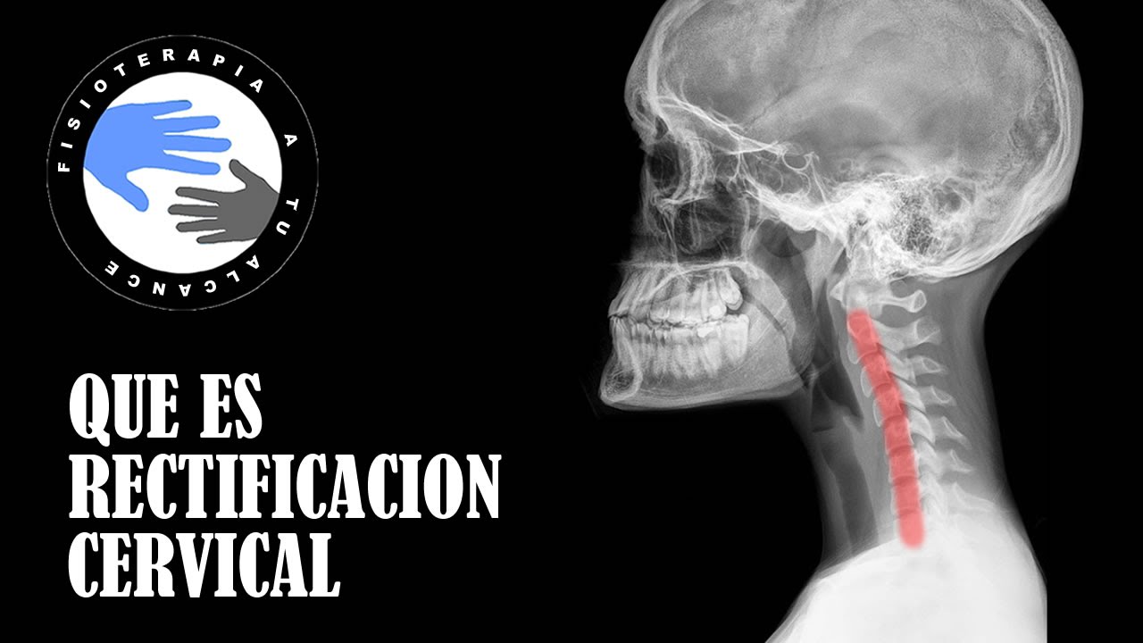 Descubre cómo corregir la lordosis cervical de manera efectiva