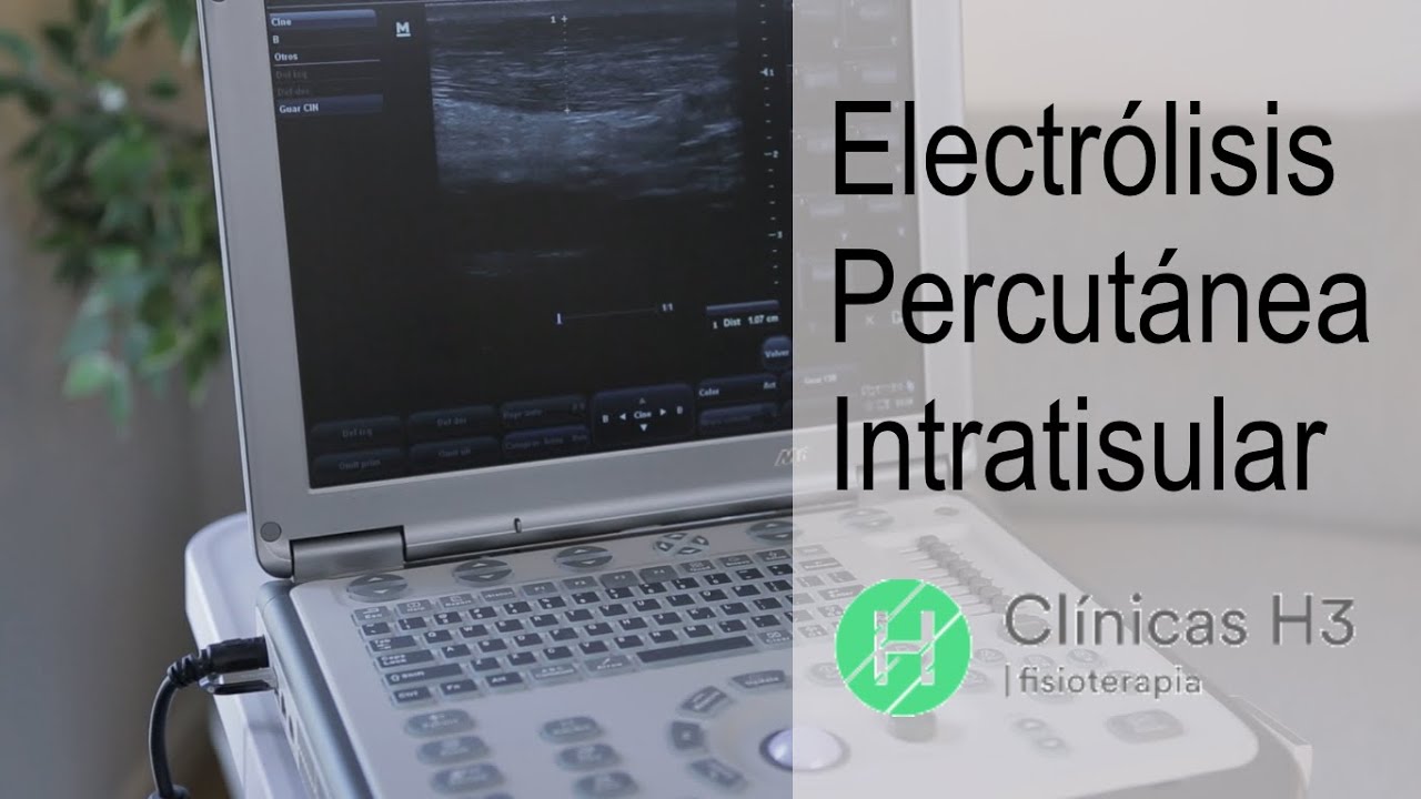 Descubre las contraindicaciones de la epi fisioterapia: ¿Deberías preocuparte?