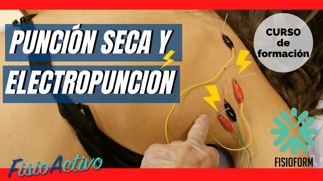 Punción seca con corrientes: el tratamiento innovador para el dolor