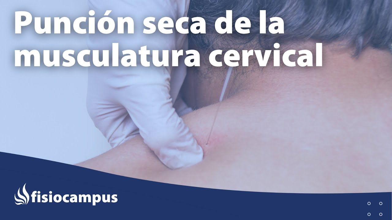 Punción seca: solución efectiva para el dolor cervical