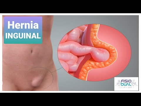 Combate la hernia inguinal caminando: ¡Recomendación médica!