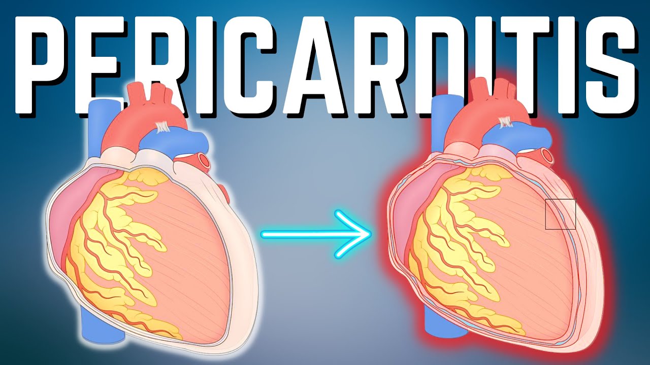 ¿La pericarditis puede afectar tu rendimiento deportivo?