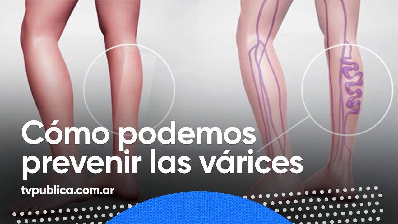 Piernas verdes: Cómo reducir la apariencia de las venas visibles