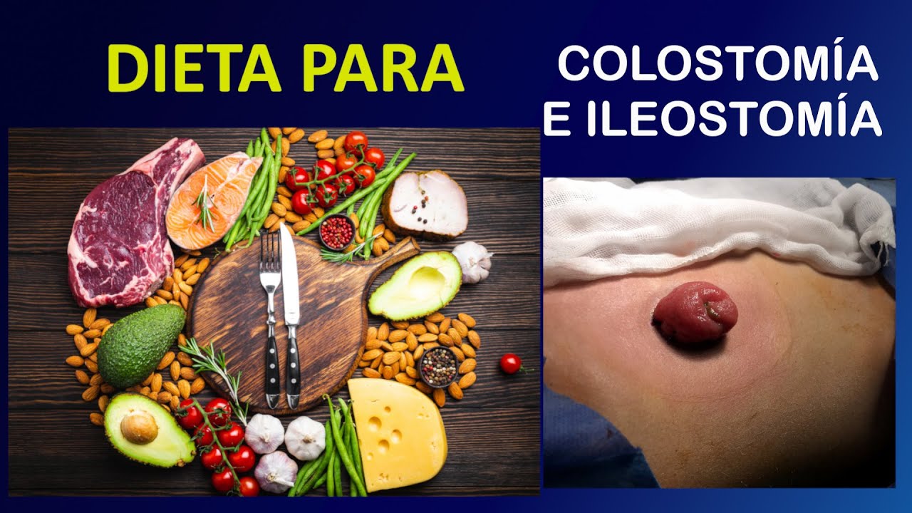 Menú adaptado para colostomía que te hace disfrutar de la comida