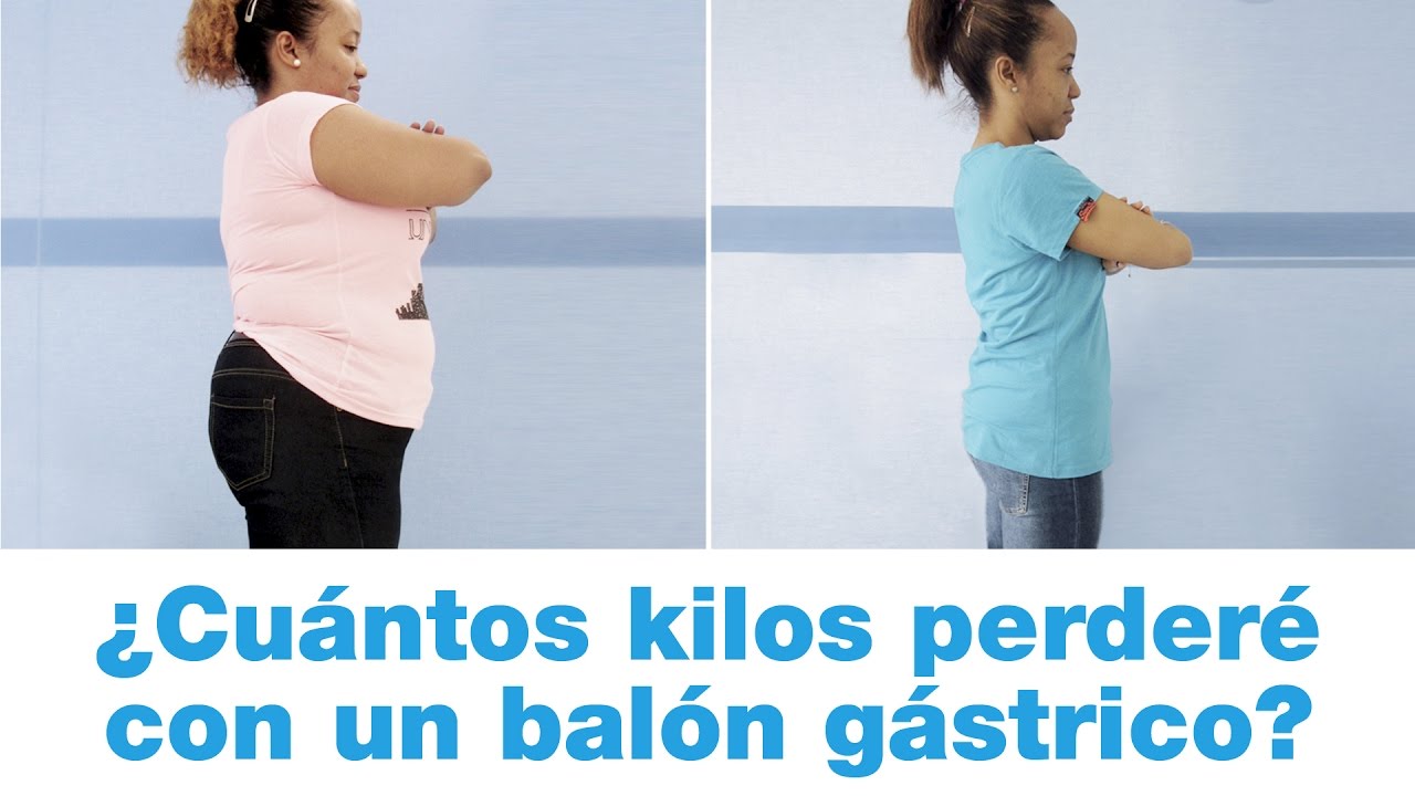 Pierde peso sin cirugía: ¿Cuántos kilos puedes perder con un balón gástrico?