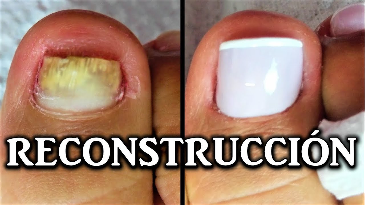 Preserva tú bienestar: Descubre el protector de uñas de los pies